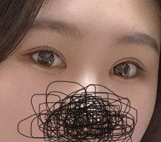 They really deserve the nickname canthoplasty specialist~ 现代美学整形外科 is the best!