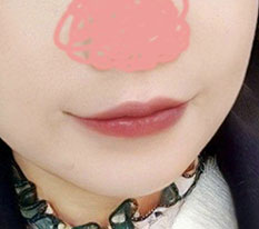 之前发过嘴角手术两个月后记，现在三个月了再来发一篇三个月后记 ><