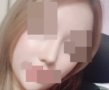 鼻子手术后感