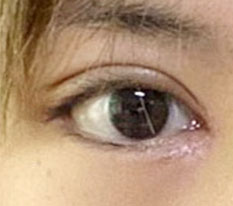 眼部修复手术一周后