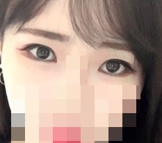 Totally satisfied with 现代美学整形外科 eye-shape correction♥