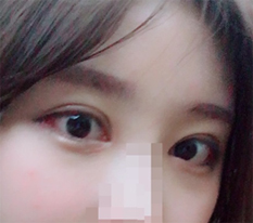 双眼皮手术大满意!!