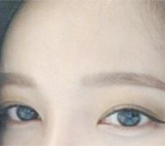 眼部整形后记☆.☆