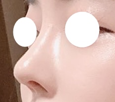 因为鼻整形经常被说变漂亮了