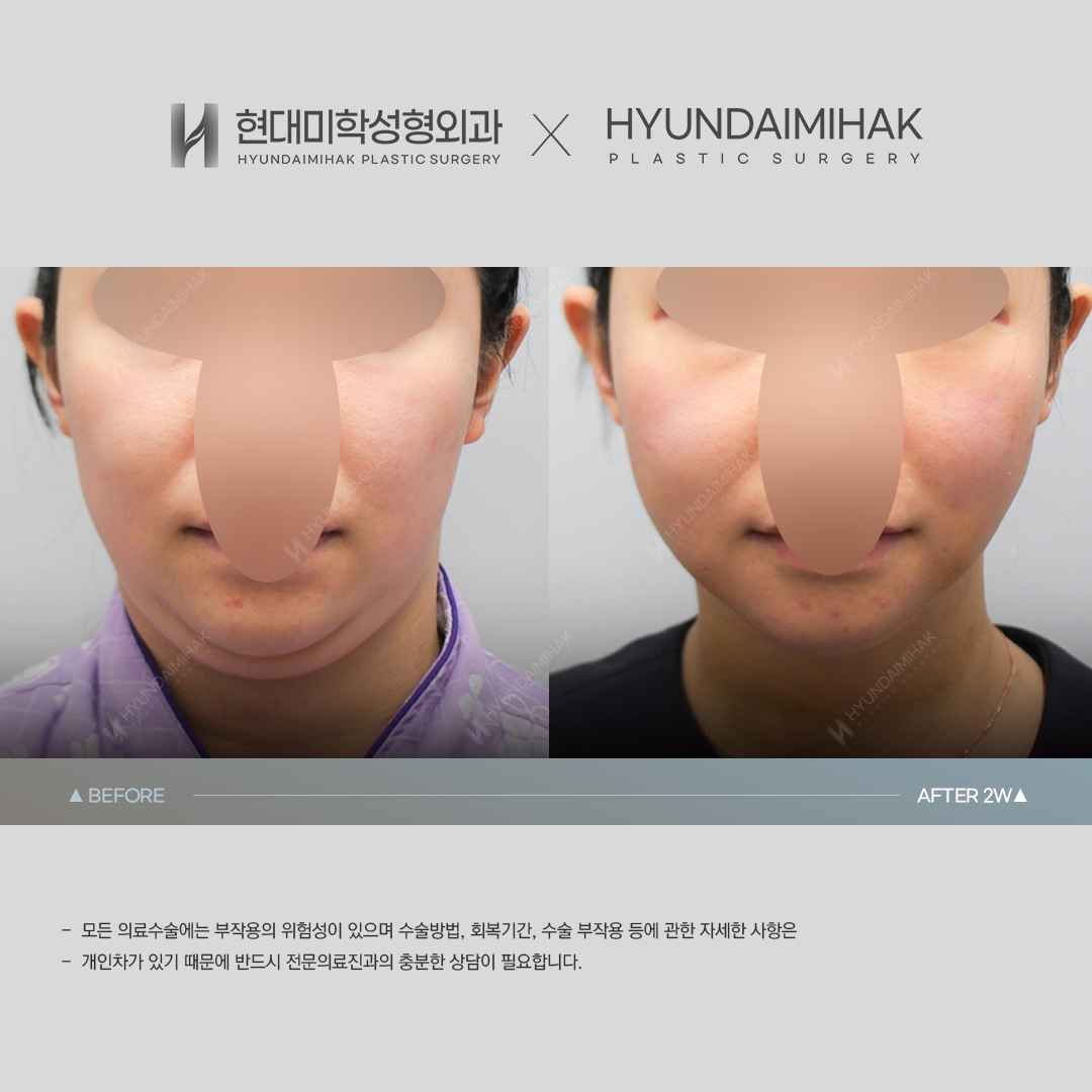 【提升】双下巴线雕提升 第2周