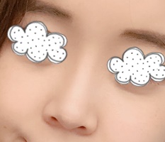鼻部整形后开始恋爱啦~
