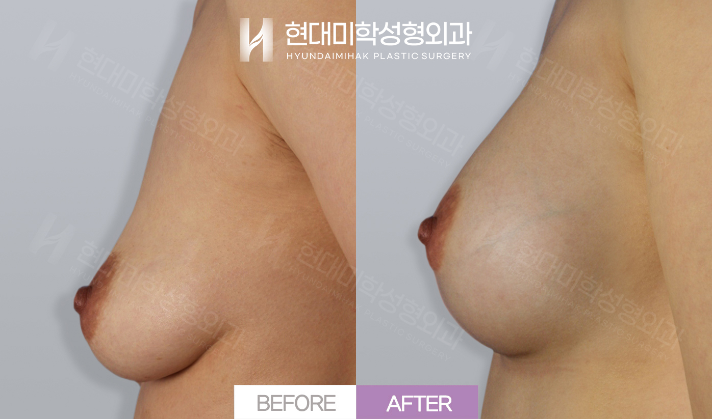 隆胸（乳房下垂）