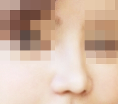 鼻部整形非常满意
