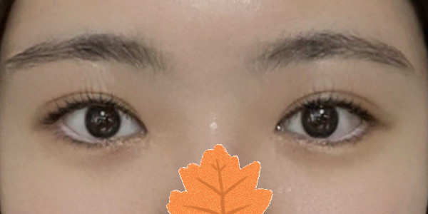 内外双双眼皮成功了！ㅎㅎㅎ