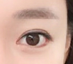 I had revision canthoplasty at 现代美学整形外科, the best~