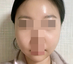 One month after cheekbone and square-jaw reduction surgery