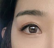 这对我来说是最后一次机会，眼睛修复手术终于成功了 ㅎ