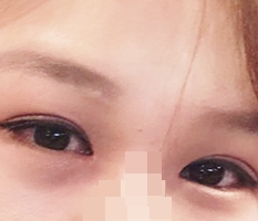 切开、眼肌矫正、开内眼角、双重开眼角