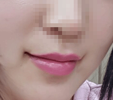 来发嘴角整形评价~