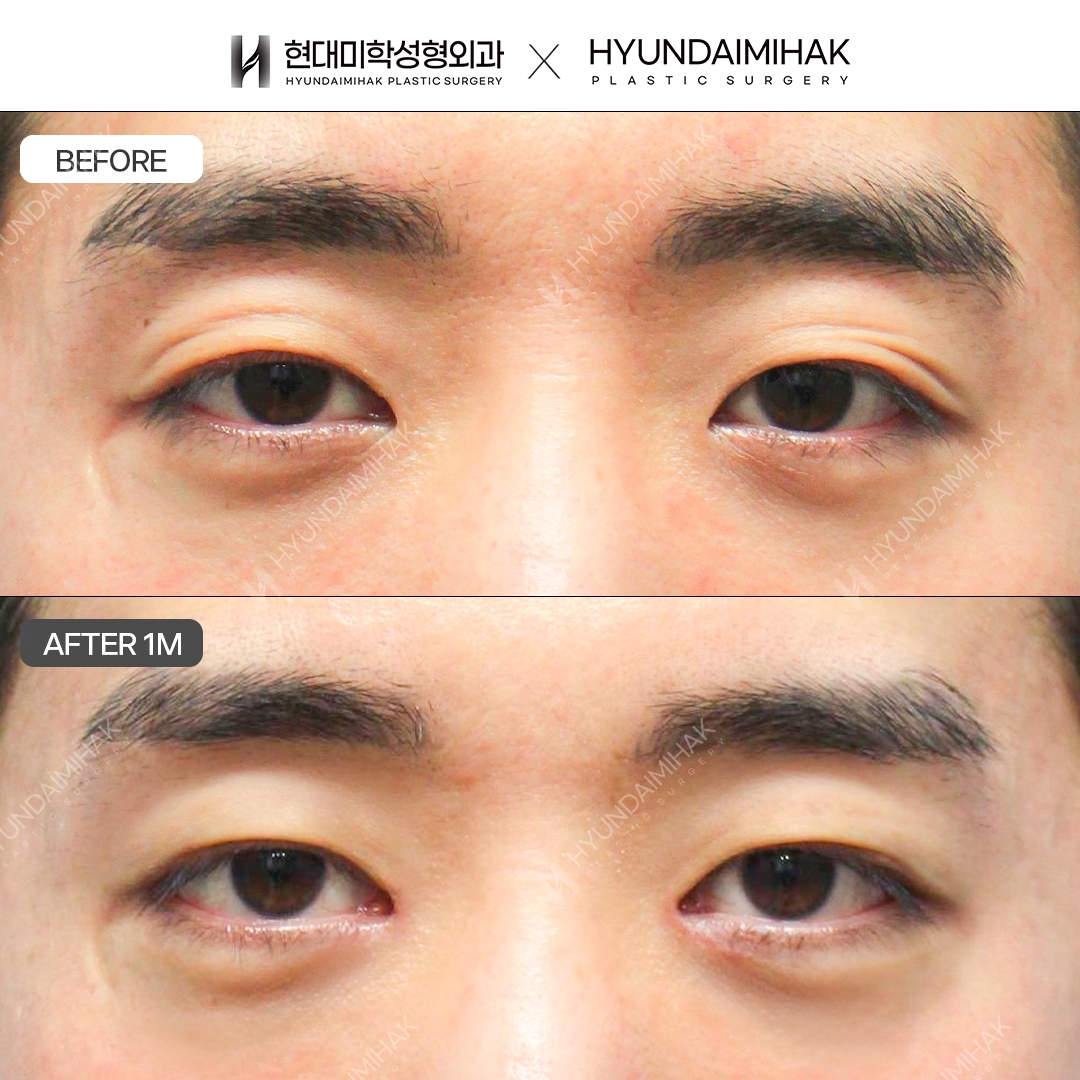 [男士眼部整形] 非切开眼形矫正 + 开内眼角