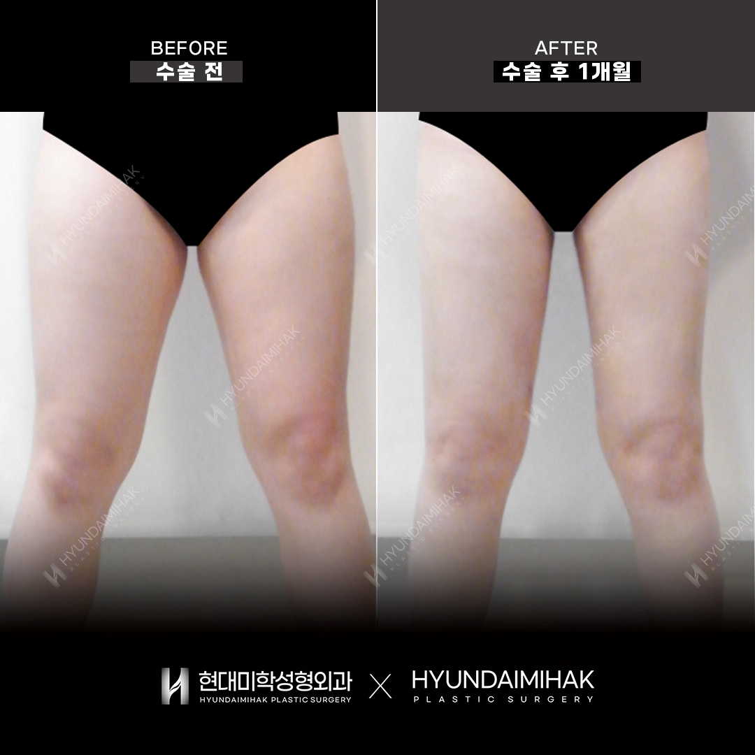 大腿吸脂术后1个月