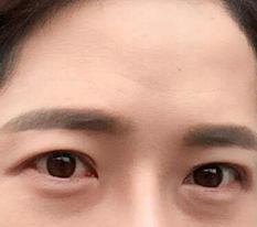 做了双眼皮和眼型矫正。