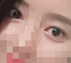 眼部修复手术+眼睑下垂矫正