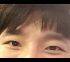 眼睛手术后感 ㅋ