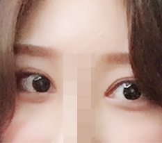 果然承认现代美学整形外科眼部手术做得好 *=_=*!!!