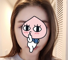 让我有压力的颧骨在现代美学整形外科解决了^.^