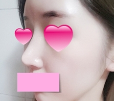 鼻修复手术评价~~