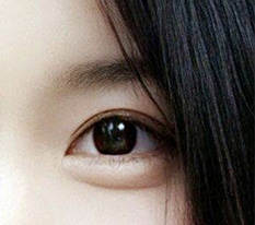 我眼部修复手术成功了对吧？？ ㅎㅎ