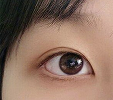 双眼皮手术三个月来再次留评