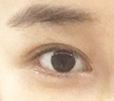做完双眼皮修复，线条活过来了..呜呜