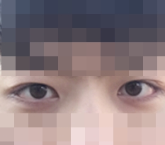 一直想要的双眼皮