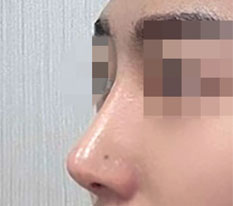 做了鼻子之后一直有人说我变帅了