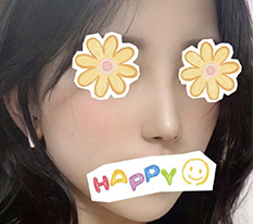 在现代美学整形外科做鼻子手术已经7个月了 ㅎㅎㅎ