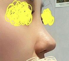 来分享鼻部手术第3周的心得