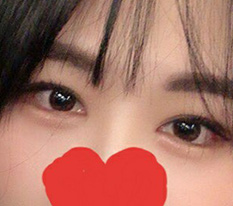 双重开眼角完全满意的评价^^