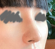 修好了鹰钩鼻，大家都说我变得更有男人味了