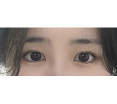 外下眦成形术后感想~~~