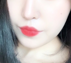 非常非常满足的嘴角手术!!
