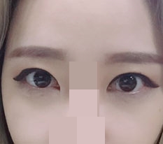 我做了双眼皮和双重开眼角！