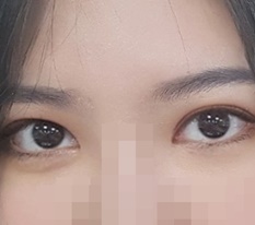 切开双眼皮、开内眼角后记 : )