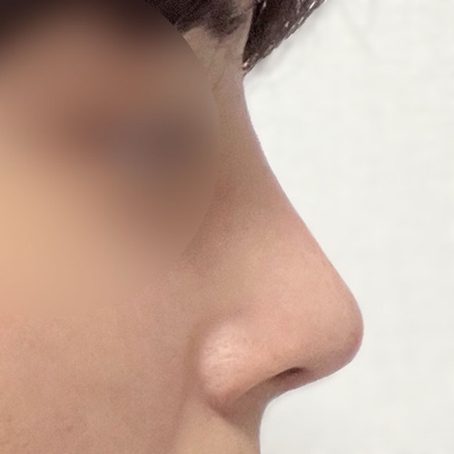 男生第一次鼻整形挑战记
