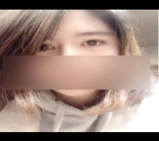 切开双眼皮、开眼角、鼻中隔手术简短感想