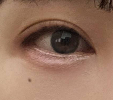 切开双眼皮才是答案