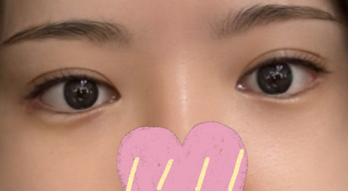 细节完美的双眼皮+开眼角评价!!