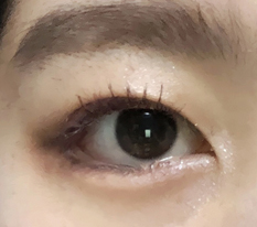 对外下眦切开很满意！