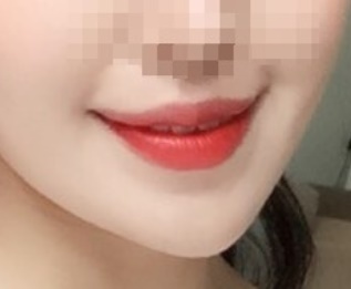 嘴角手术评价!!!!