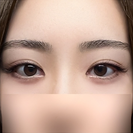 我想拥有像林宝拉一样的眼睛！(feat. 凹陷上眼皮、眼部修复)