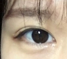 多亏院长，我的眼睛变漂亮了