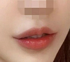 为了纪念嘴角手术来留个评 ㅎ