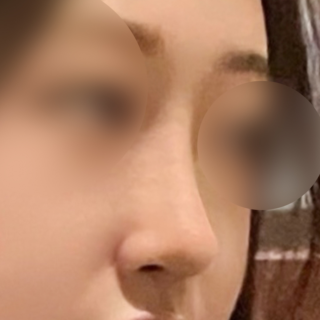 Hyundai Aesthetic Surgery first nose surgery review