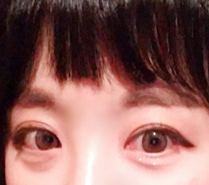 开眼角真的超棒